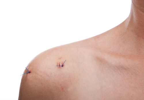 Post-Operative Management of Selected Shoulder Conditions