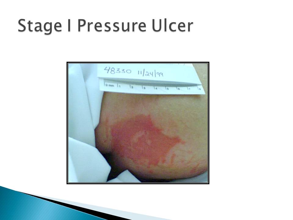 Wound Care Basic Concepts and Treatments Jennifer A Gardner Wound Care