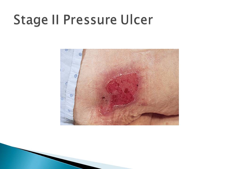 Wound Care Basic Concepts and Treatments Jennifer A Gardner Wound Care