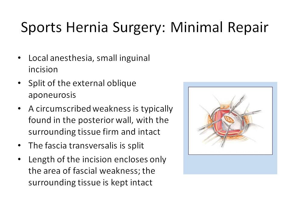 Sports hernia surgery recovery
