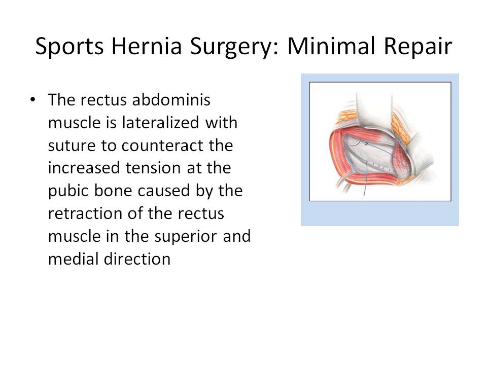 Groin Pain Steven Tippett 2042