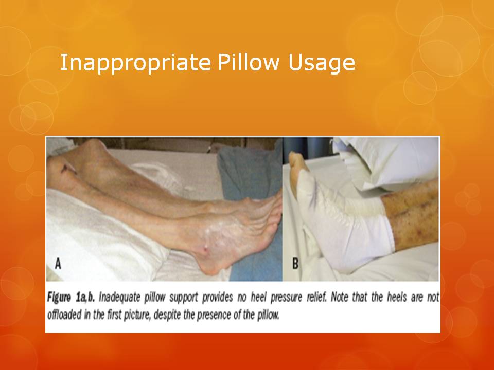 Pressure Ulcers Prevention and Treatment Jennifer A Gardner Wound Care