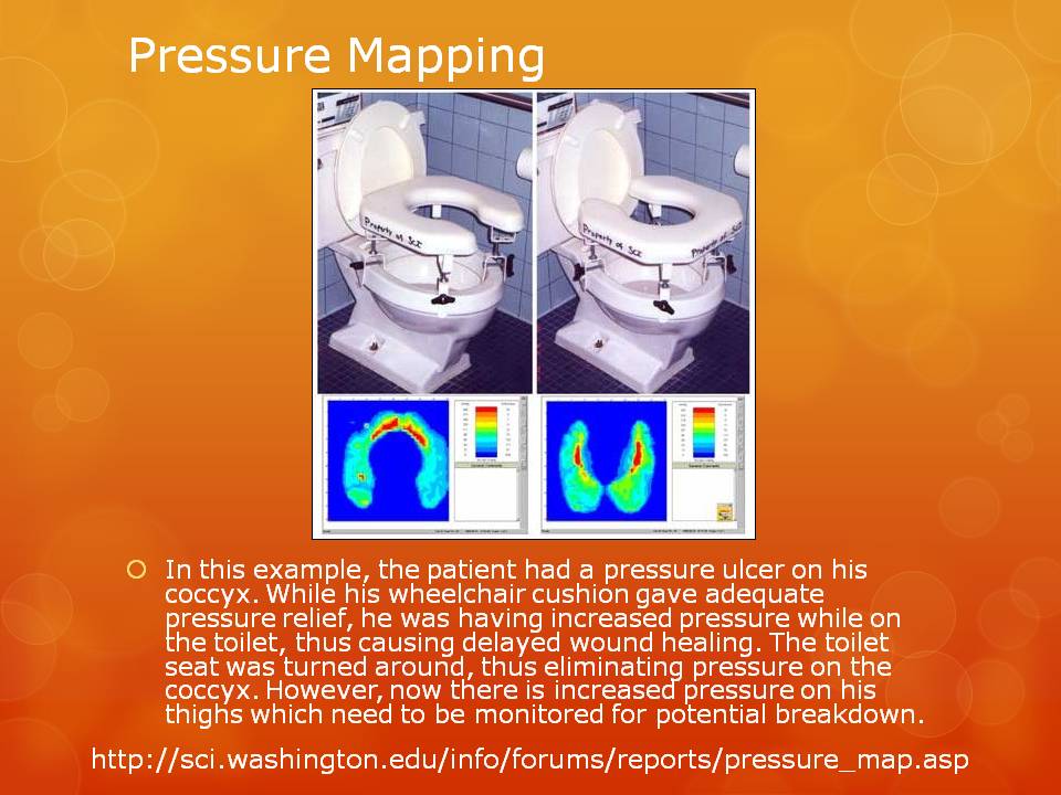 Pressure Ulcers Prevention and Treatment Jennifer A Gardner Wound Care & Lymphedema 2103