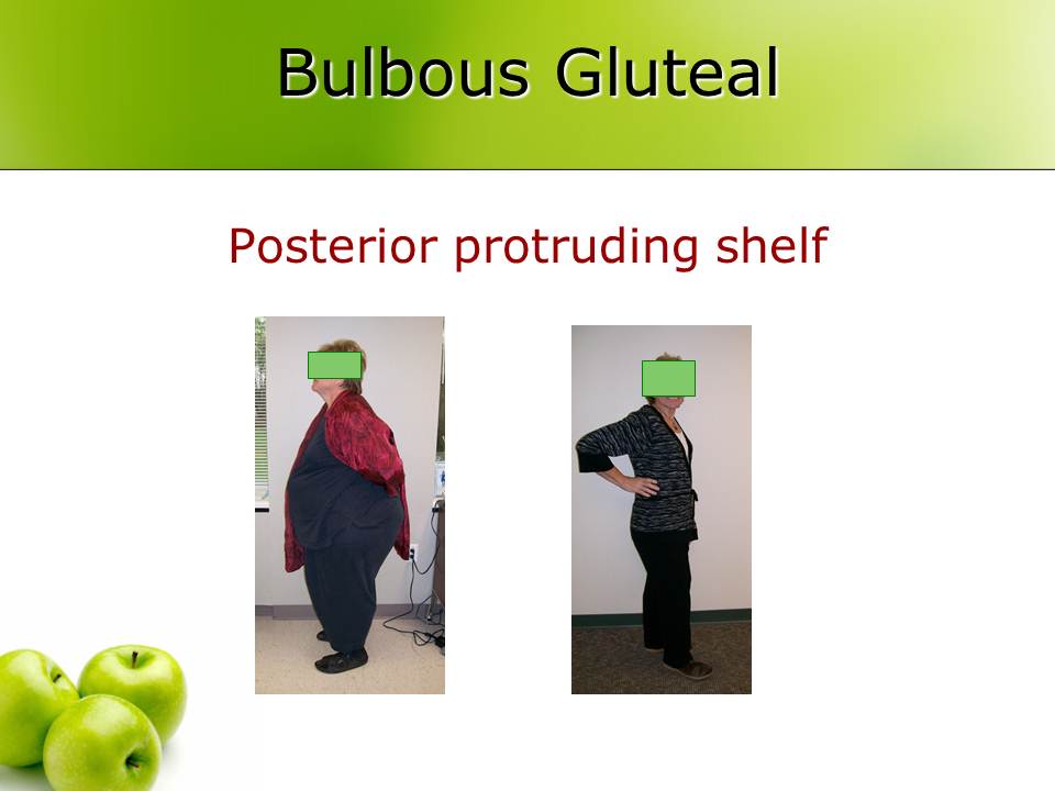 Does One Size Really Fit All? Part 2 Defining Obesity and Bariatric 1992