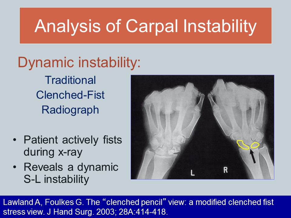 Understanding Wrist Instability Ann PorrettoLoehrke Sports Orthopedics